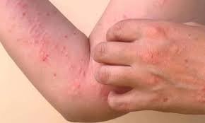 چکن گونیا کیا ہے اور اس کا کیا علاج ہے؟