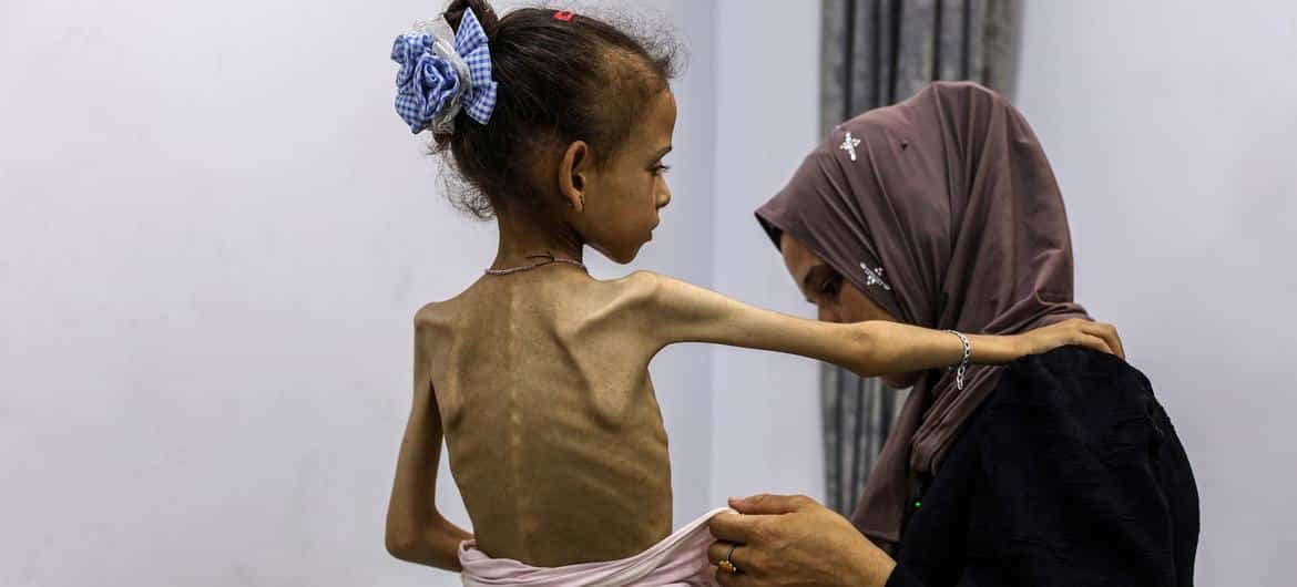 بھوک غزہ کے بچوں کی نشوونما میں رکاوٹ بنے گی، اقوام متحدہ